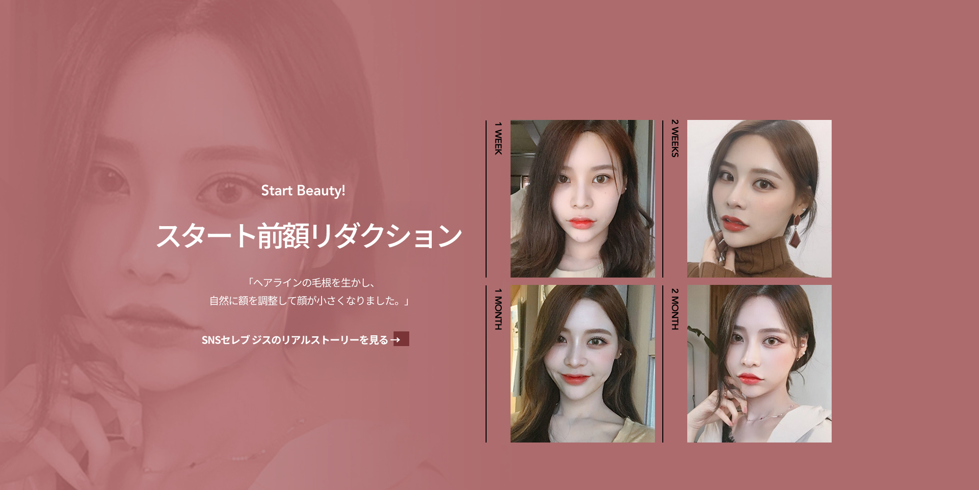 스타트 이마축소